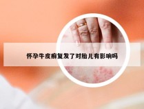 怀孕牛皮癣复发了对胎儿有影响吗
