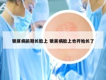 银屑病前期长脸上 银屑病脸上也开始长了