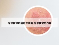 军中肤宝的治疗牛皮癣 军中肤宝的作用
