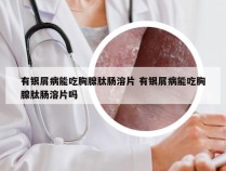 有银屑病能吃胸腺肽肠溶片 有银屑病能吃胸腺肽肠溶片吗