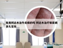 有用阿达木治牛皮癣的吗 阿达木治疗银屑病多久见效