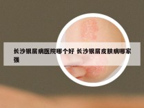 长沙银屑病医院哪个好 长沙银屑皮肤病哪家强