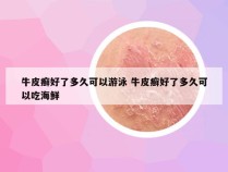牛皮癣好了多久可以游泳 牛皮癣好了多久可以吃海鲜