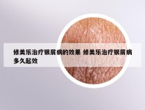 修美乐治疗银屑病的效果 修美乐治疗银屑病多久起效