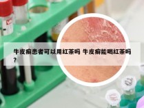 牛皮癣患者可以用红茶吗 牛皮癣能喝红茶吗?
