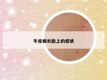 牛皮癣长脸上的症状