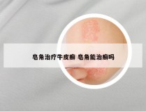 皂角治疗牛皮癣 皂角能治癣吗