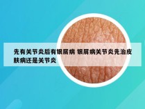 先有关节炎后有银屑病 银屑病关节炎先治皮肤病还是关节炎