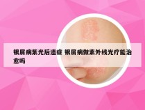 银屑病紫光后遗症 银屑病做紫外线光疗能治愈吗