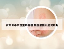 贫血会不会加重银屑病 银屑病能引起贫血吗