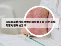 皮肤银屑病科北京哪家医院好不好 北京皮肤专家对银屑的治疗