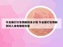 牛皮癣打针生物制剂多少钱 牛皮癣打生物制剂对人体有哪些伤害