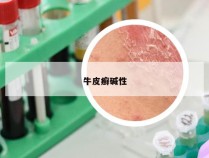 牛皮癣碱性