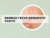 银屑病要治好了再怀孕吗 银屑病患者可以怀孕生孩子吗
