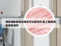 银屑病脸部表皮增生可以激光吗 脸上银屑病能做美容吗