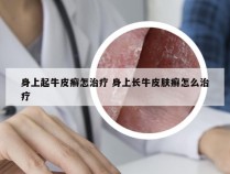 身上起牛皮癣怎治疗 身上长牛皮肤癣怎么治疗