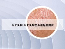 头上头癣 头上头癣怎么引起的图片