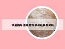 银屑病与经典 银屑病与经典有关吗