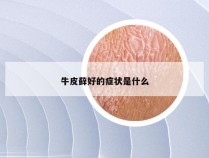 牛皮藓好的症状是什么