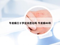 牛皮癣三十岁还会恶化吗 牛皮癣40年