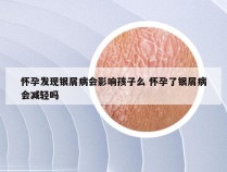 怀孕发现银屑病会影响孩子么 怀孕了银屑病会减轻吗