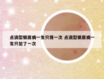 点滴型银屑病一生只得一次 点滴型银屑病一生只犯了一次