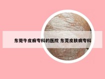 东菀牛皮癣专科的医院 东莞皮肤病专科