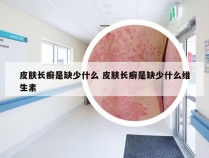 皮肤长癣是缺少什么 皮肤长癣是缺少什么维生素