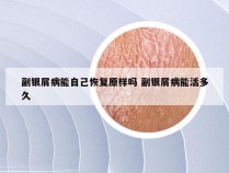 副银屑病能自己恢复原样吗 副银屑病能活多久