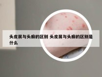 头皮屑与头癣的区别 头皮屑与头癣的区别是什么