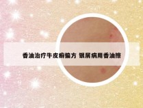 香油治疗牛皮癣偏方 银屑病用香油擦
