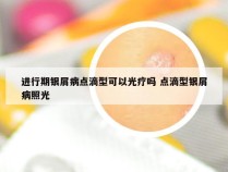 进行期银屑病点滴型可以光疗吗 点滴型银屑病照光