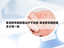 美宝牌胃肠胶囊治疗牛皮癣 美宝牌胃肠胶囊多少钱一瓶
