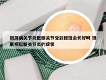 银屑病关节炎骶髂关节受到侵蚀会长好吗 银屑病骶髂关节炎的症状
