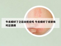 牛皮癣好了之后会脱皮吗 牛皮癣好了皮肤有时还很痒