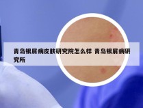 青岛银屑病皮肤研究院怎么样 青岛银屑病研究所