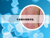 牛皮癣从哪里开始