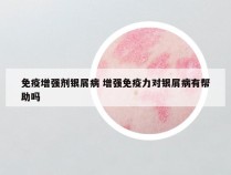 免疫增强剂银屑病 增强免疫力对银屑病有帮助吗