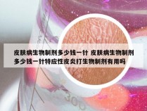皮肤病生物制剂多少钱一针 皮肤病生物制剂多少钱一针特应性皮炎打生物制剂有用吗