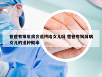 爸爸有银屑病会遗传给女儿吗 爸爸有银屑病女儿的遗传概率