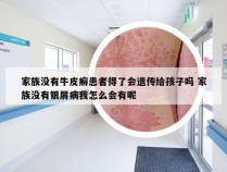 家族没有牛皮癣患者得了会遗传给孩子吗 家族没有银屑病我怎么会有呢