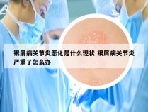 银屑病关节炎恶化是什么现状 银屑病关节炎严重了怎么办