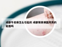 成都牛皮癣怎么引起的 成都银屑病医院真的能医吗