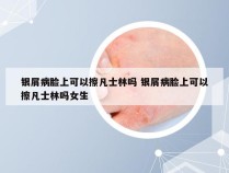 银屑病脸上可以擦凡士林吗 银屑病脸上可以擦凡士林吗女生