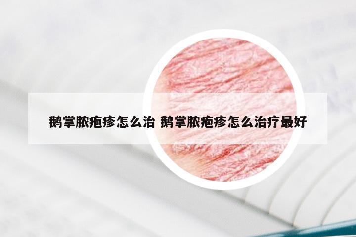 鹅掌脓疱疹怎么治 鹅掌脓疱疹怎么治疗最好