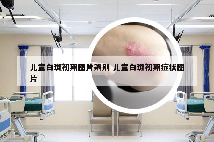 儿童白斑初期图片辨别 儿童白斑初期症状图片