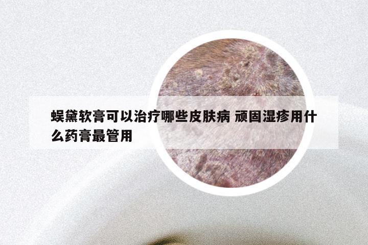 蜈黛软膏可以治疗哪些皮肤病 顽固湿疹用什么药膏最管用