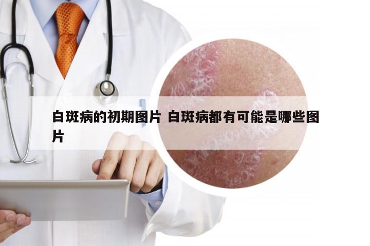 白斑病的初期图片 白斑病都有可能是哪些图片