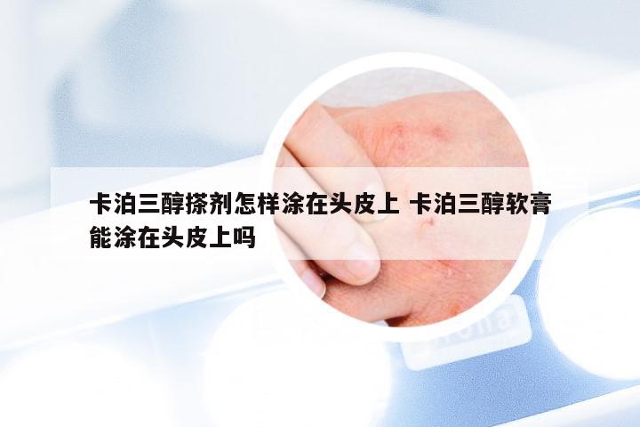 卡泊三醇搽剂怎样涂在头皮上 卡泊三醇软膏能涂在头皮上吗