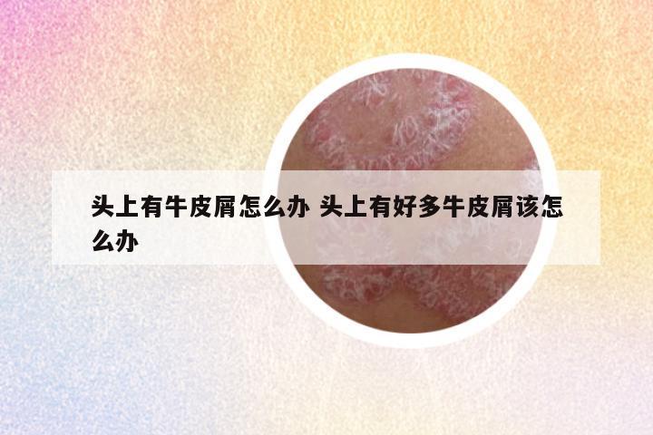 头上有牛皮屑怎么办 头上有好多牛皮屑该怎么办